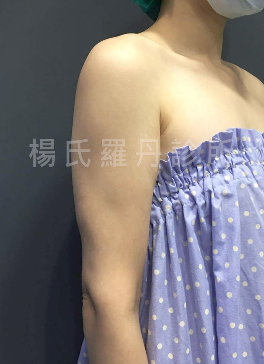 雷射減脂